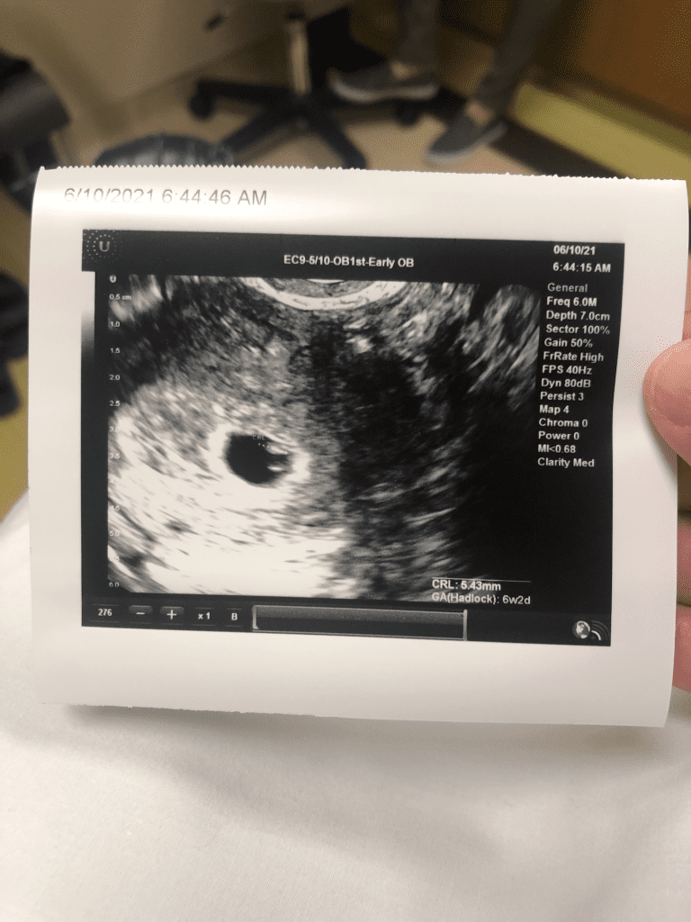 6 week ultrasound picture June 2021